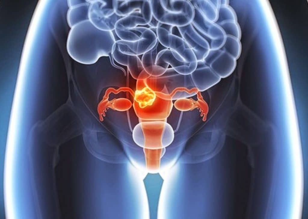 Cancer do colo de utero 1024x728 1